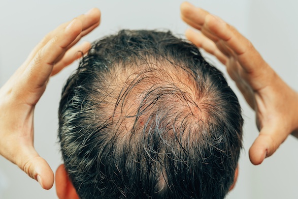 Microneedling gegen Haarausfall