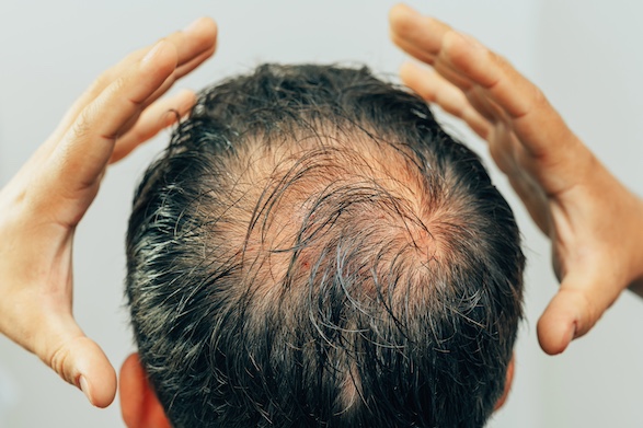 Microneedling gegen Haarausfall - Besseres Haarwachstum mit Dermaroller oder Dermapen Microneedling gegen Haarausfall