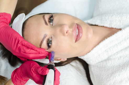 Microneedling Behandlung Augen Mit Microneedling Augen schöner aussehen lassen