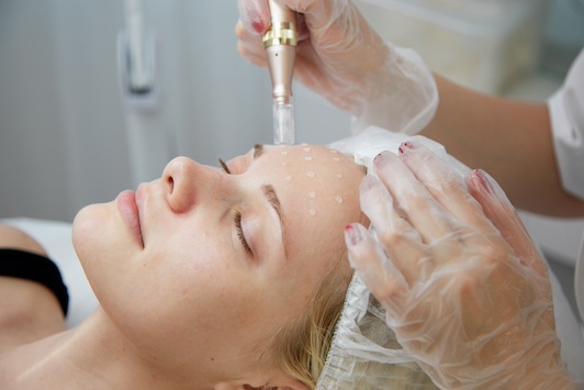 Microneedling-Behandlung der Stirn mit Serum und Dermapen