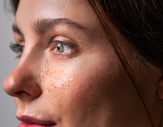 Frau mit fettiger, öliger großporiger Haut Ölige großporige Haut, ideal für die Behandlung mit dem Oily Skin Cocktail - steriles Microneedling Serum