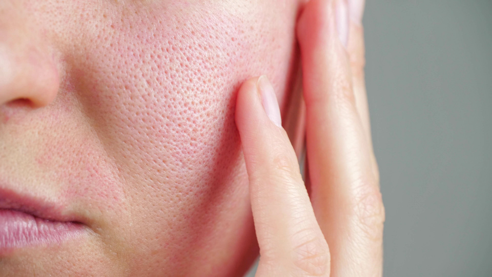 Haut mit großen Poren - ideal für eine Microneedling Behandlung