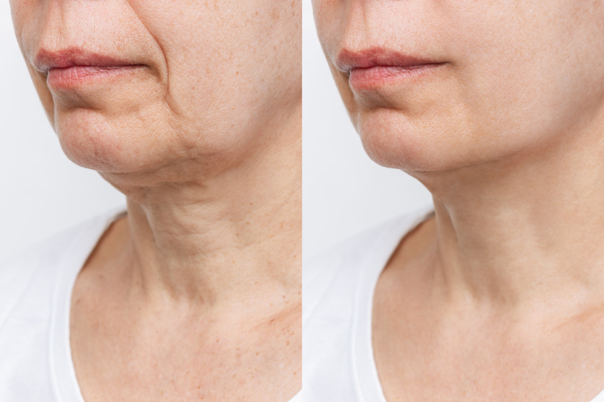 Frau mit schlaffer Gesichtshaut - ideal für eine Microneedling Behandlung