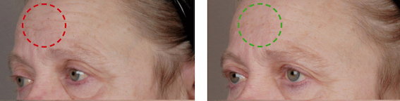 Stirnfalte nach Behandlung mit sterilem Microneedling Serum Placent.5